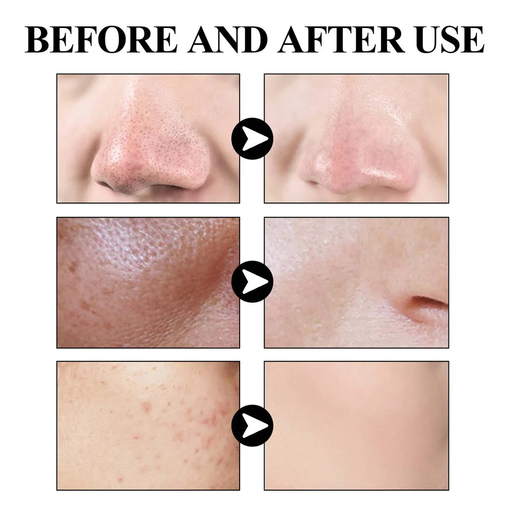 West & Month Blackhead Removal Mud Mask
